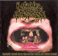 Blenorrhagical Spermatocystitis : Bacteria Travel Down the Rotten Teeth and Cause Cancer